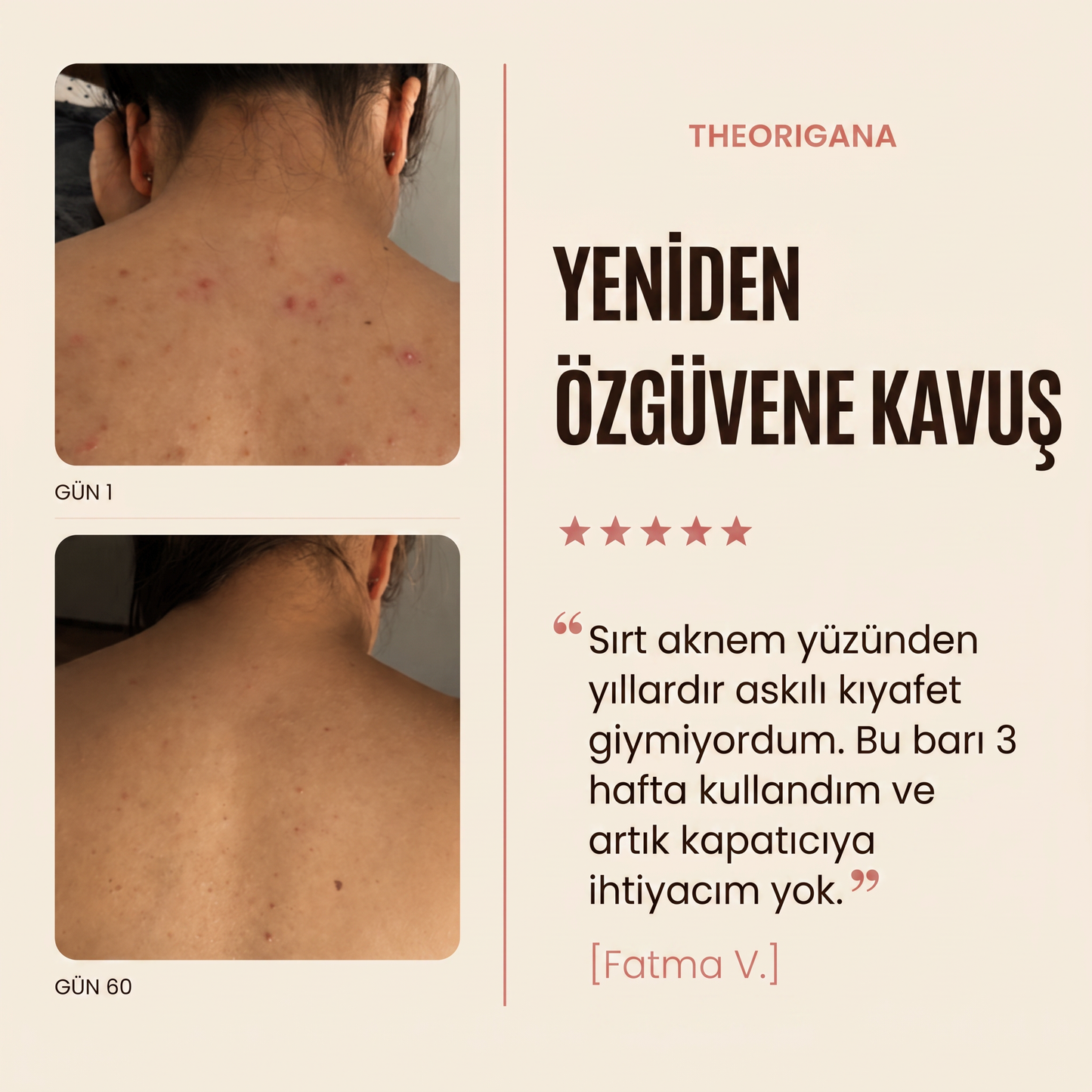 Sırt ve Gövde Aknelerine Karşı Bar Sabunu – Akne ve Sivilce Giderici