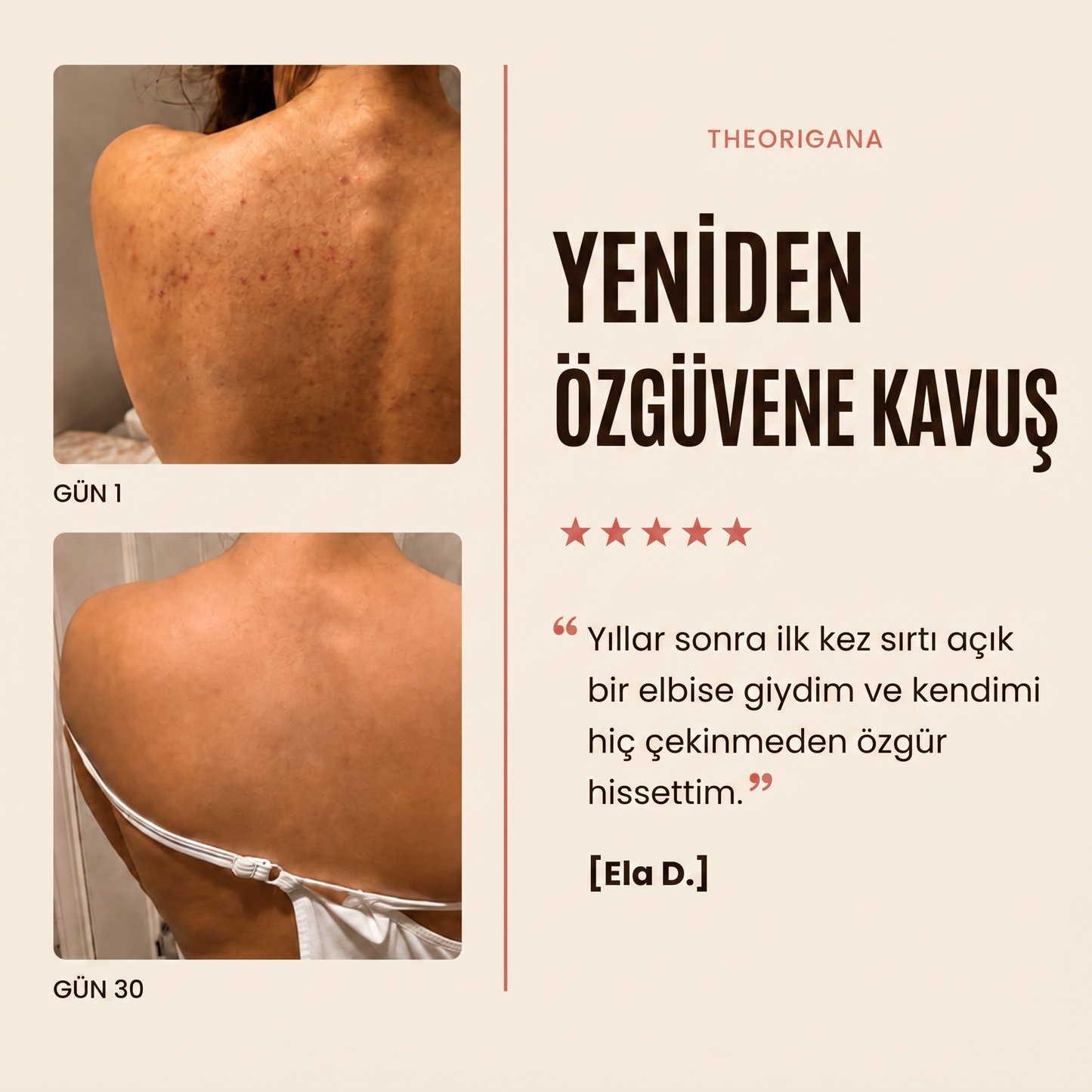 Sırt ve Gövde Aknelerine Karşı Bar Sabunu – Akne ve Sivilce Giderici