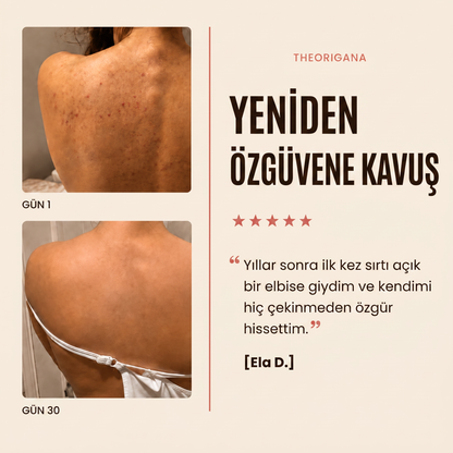 Sırt ve Gövde Aknelerine Karşı Bar Sabunu – Akne ve Sivilce Giderici