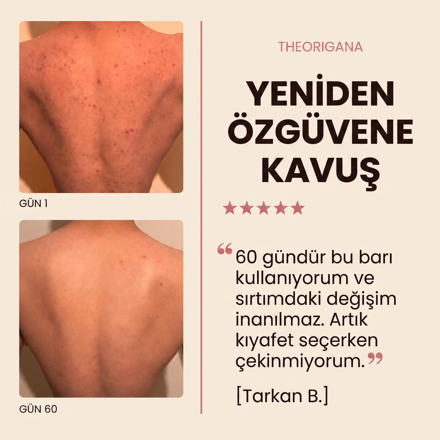 Sırt ve Gövde Aknelerine Karşı Bar Sabunu – Akne ve Sivilce Giderici