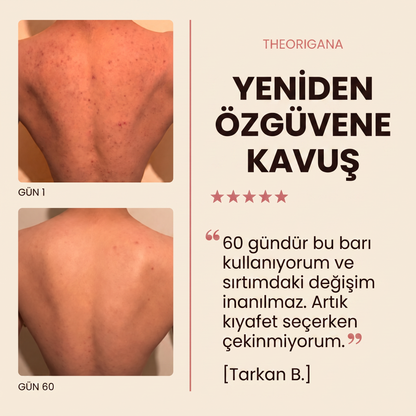 Sırt ve Gövde Aknelerine Karşı Bar Sabunu – Akne ve Sivilce Giderici