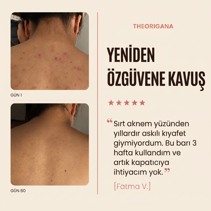 Sırt ve Gövde Aknelerine Karşı Bar Sabunu – Akne ve Sivilce Giderici