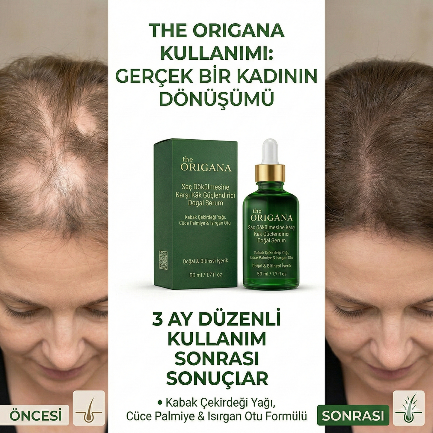 Saç Dökülmesini Durduran Ve Saçları Yenileyen Güçlü Doğal Serum